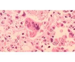 В Нью-Йорке подтвердили первый случай кори в 2026 году